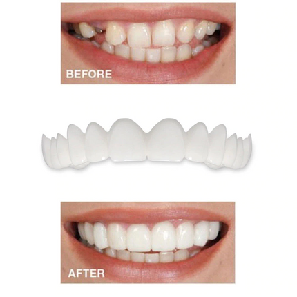 Instant Smile Snap-On Veneers | Upper & Lower Set | Natural Looking Teeth Cover | Disguise Crooked, Stained, Missing & Gapped Teeth | Comfortable Fit | Unisex | Safe & Easy to Use | One Size Fits Most