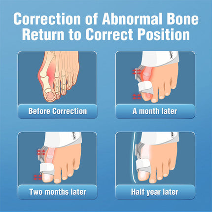 Upgraded 3D Knob Toe Alignment Device | Natural Position Correction | Adjustable Angle for Valgus Repair | High-Quality Material | Multi-Size Compatibility