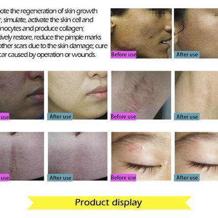 Ginseng Extract Acne Scar Cream | Reduce Pimples & Marks | Restore & Smooth Skin | Personal Care