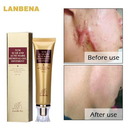 Ginseng Extract Acne Scar Cream | Reduce Pimples & Marks | Restore & Smooth Skin | Personal Care