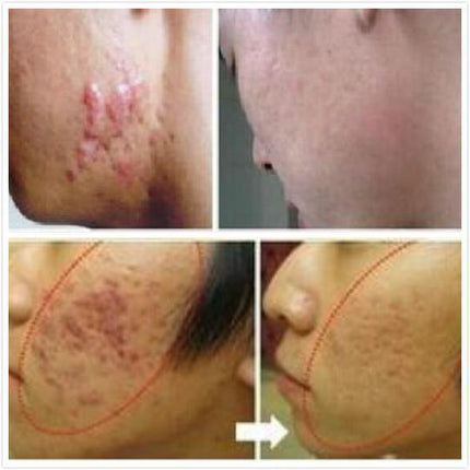 Ginseng Extract Acne Scar Cream | Reduce Pimples & Marks | Restore & Smooth Skin | Personal Care