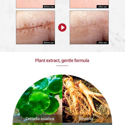 Ginseng Extract Acne Scar Cream | Reduce Pimples & Marks | Restore & Smooth Skin | Personal Care